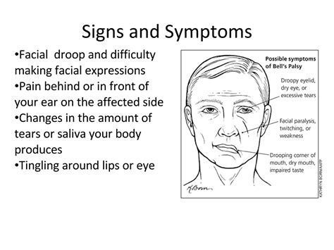 Bells Palsy Part 1 Ppt