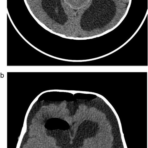 A Axial T2 Weighted Sequence Showing Vein Of Galen Malformation B