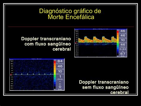 Exame De Doppler Transcraniano Em Sp Doppler Transcraniano