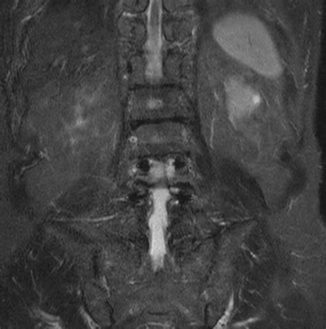 Lumbar Spine With Metal Suppression Philips Mr Body Map