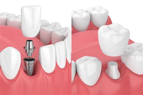 How Dental Crowns Can Restore Your Smile Beaufort Center For Dentistry