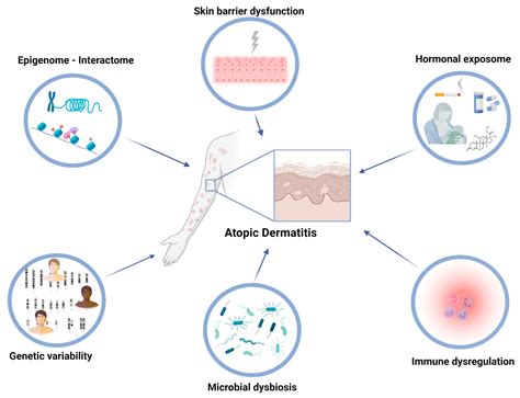 Factors Contributing To Atopic Dermatitis Development Encyclopedia Mdpi