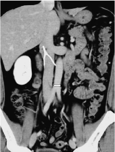 Contrast Enhanced Abdominal Computed Tomography Scan Image Coronal