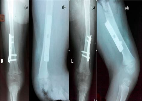 Figure 5 From Congenital Aplasia Of The Patella And The Distal Third Of