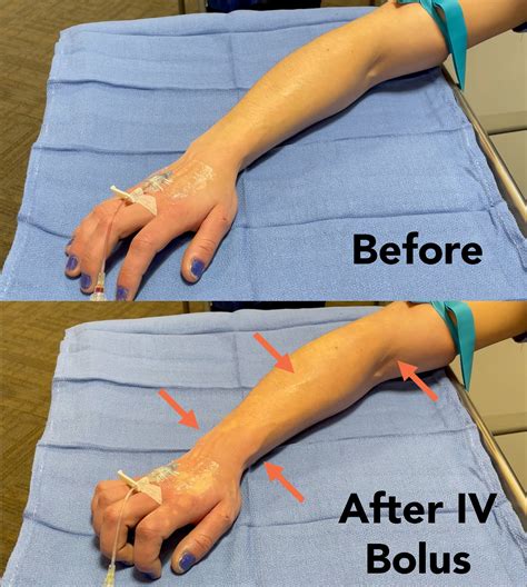 Distal Veins