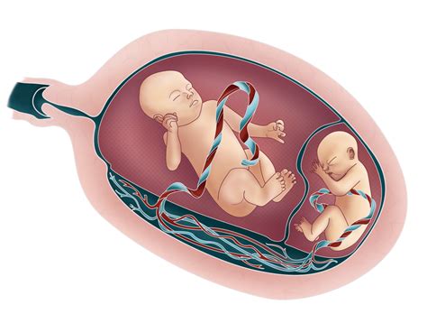 Síndrome Da Transfusão Feto Fetal Gestar Medicina E Cirurgia Fetal