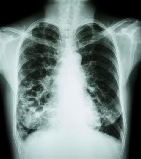 Insmed to Present Abstracts on NTM Lung Infection Therapy