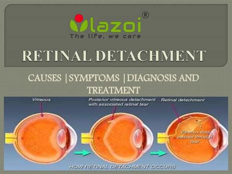 Retinal detachment : Causes, symptoms and treatment