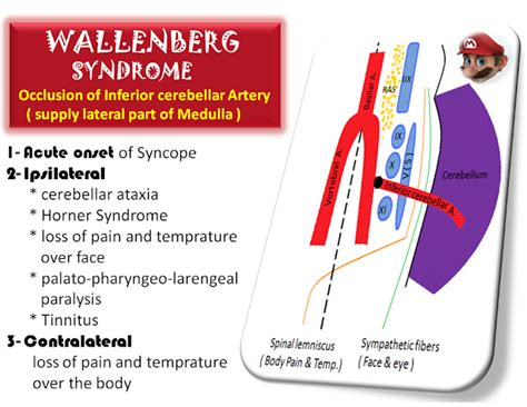 Wallenberg Syndrome-Occlusion of Inferior Cerebellar Artery ~ Medicosapiens