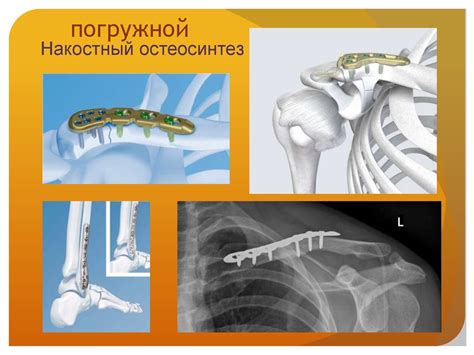 Виды остеосинтеза - презентация онлайн