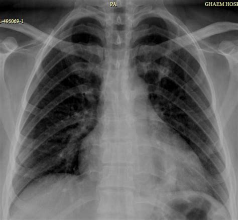 Pa Chest Radiograph Shows Which Does Not Reveal Any Mediastinal Download Scientific Diagram