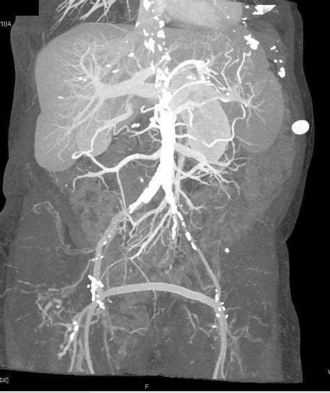 Carcinoid Tumor In The Small Bowel Small Bowel Case Studies Ctisus