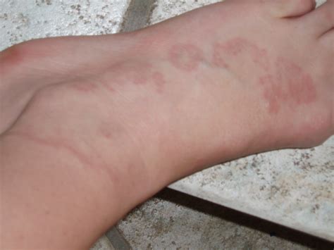 Red Skin Rash On Top Of Foot My Xxx Hot Girl Hot Sex Picture