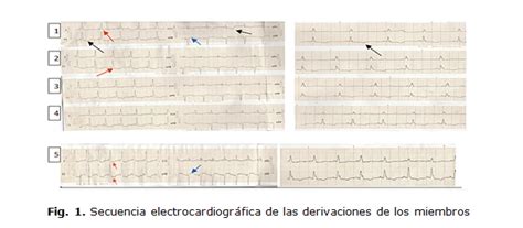 Alteraciones electrocardiográficas en un paciente con hemorragia