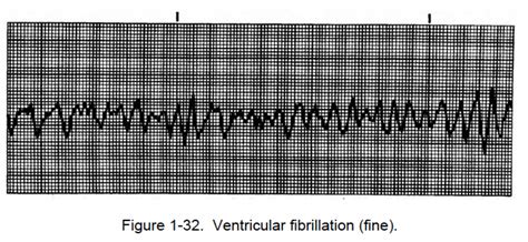 Fine Ventricular Fibrillation