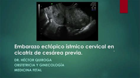 Embarazo Ectópico Istmico Cervical En Cicatriz De Cesárea Previa Youtube