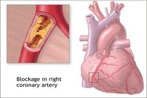 Symptoms of RCA blockage Archives | Dr. Vikram Chauhan's Blog