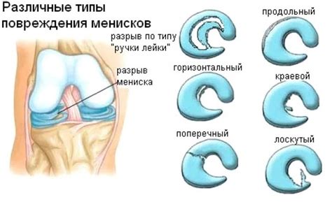 РАЗРЫВ МЕНИСКА: операция или физическая терапия? Результаты некоторых ...