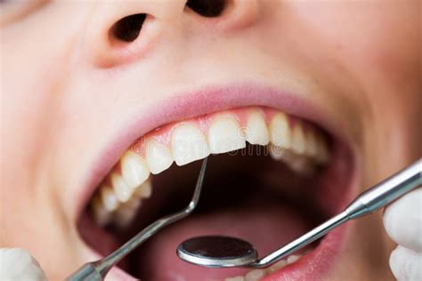 Close Up Of Female With Open Mouth During Oral Checkup At The Dentist