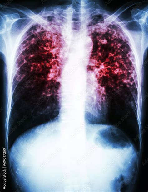 Mycobacterium Tuberculosis Infection Pulmonary Tuberculosis Stock