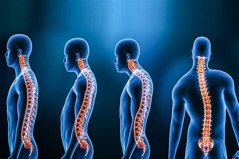 Neurology Of Posture Spinal Alignment And Scoliosis Sunset