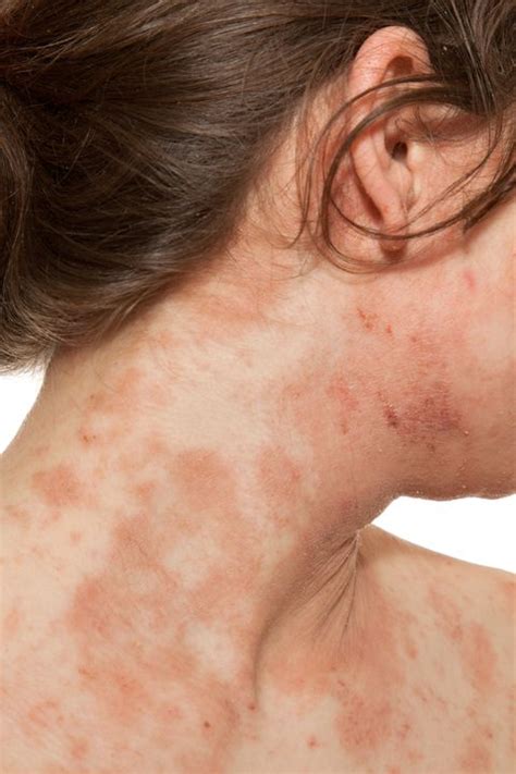 Allergic Reaction To Makeup Rash - Mugeek Vidalondon