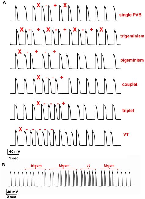 A) (top to bottom) isolated arrhythmia, trigeminy complex, bigeminy ...