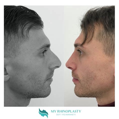 Chirurgia Plastica Naso Cose Che Devi Sapere My Rhinoplasty