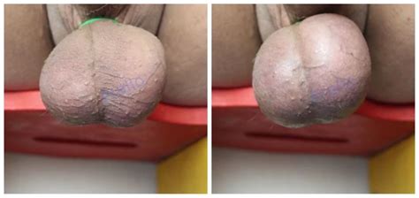 Complete Minutes Double Elastrator Castration Time Lapse Gay