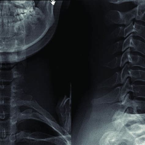 Ap And Lateral Radiographs Of Our Patient With Debilitating Neck And Download Scientific