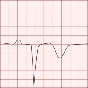 Pathologic Q-wave - Differential Diagnosis of