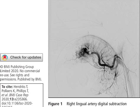 Figure 1 From Tongue Arteriovenous Malformation With Oral Haemorrhage