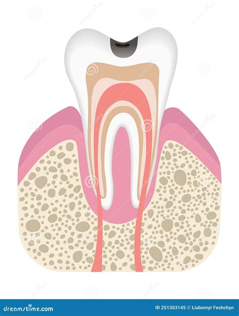 Caries Development. Dental Disease Stages: Enamel And Dentin Caries