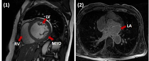 Examples Of Cine Short Axis Left And Lge Mr Right Images With