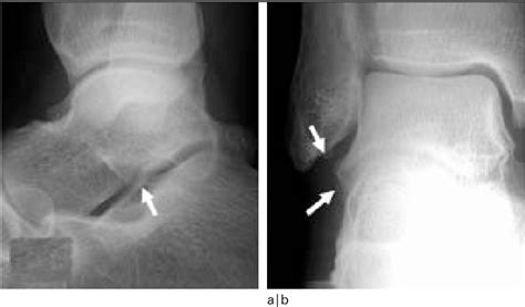 Figure From Aspects Radiographiques Des L Sions Ost O Articulaires Et