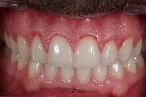 Gingivitis Necrotizante S Ntomas Y Tratamiento Dobleese