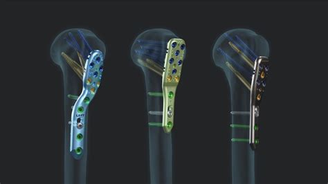 Arthrex Humeral Plating System