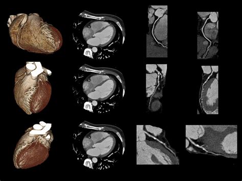 Cardiac CT St Joseph S Imaging