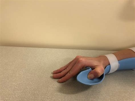 Hand Therapy - Exercises following Extensor Pollicis Longus (EPL