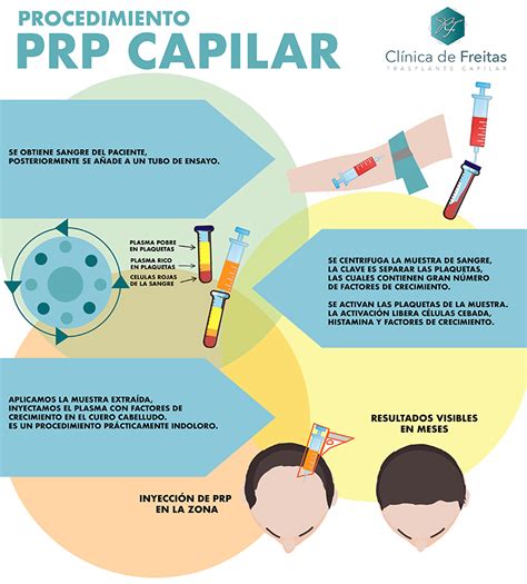 Qué es el prp capilar y como funciona Clínica de Freitas