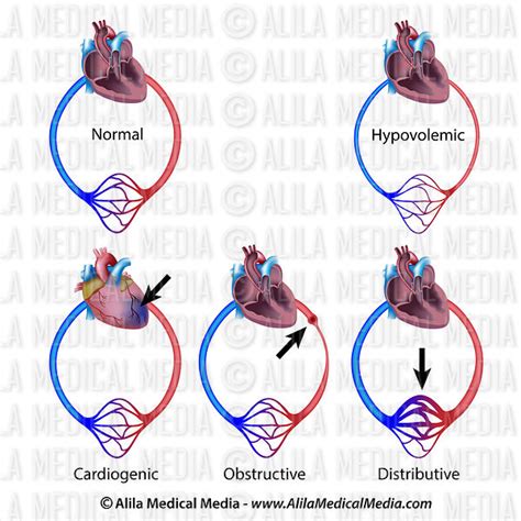 Alila Medical Media Types Of Circulatory Shock Medical Illustration