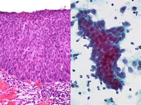 Carcinoma In Situ Flashcards Quizlet