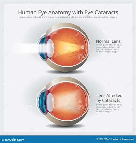 Human Eye Anatomy and Normal Lens Stock Vector - Illustration of chart ...