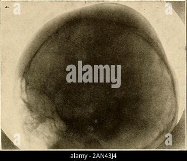 Roentgen Diagnosis Of Diseases Of The Head Roentgenogram The Sella