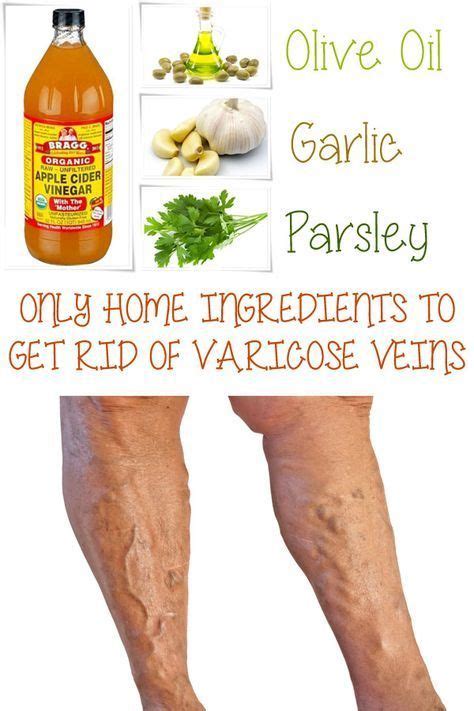 Home Remedies For Spider Veins Artofit