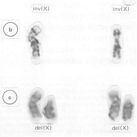 Figure Sex Chromosome Complements From Two Different Metaphases Derived