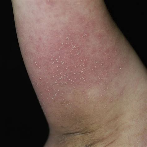 Multiple Diffuse Erythematous Maculopatches Studded With Several