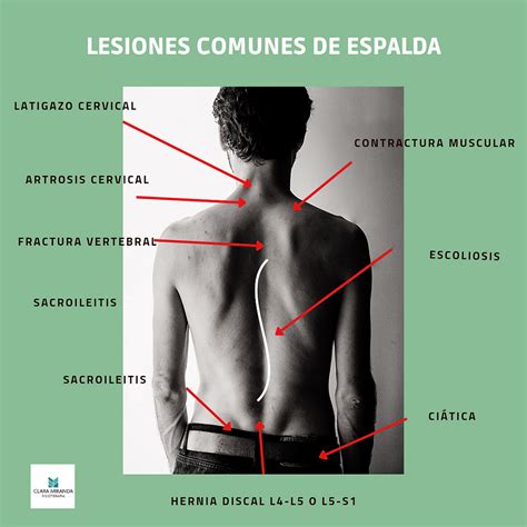 Lesiones M S Frecuentes En La Espalda