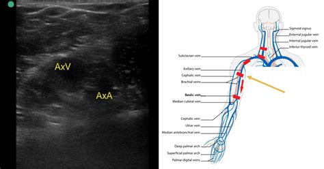 Sonoguide Deep Vein Thrombosis Dvt