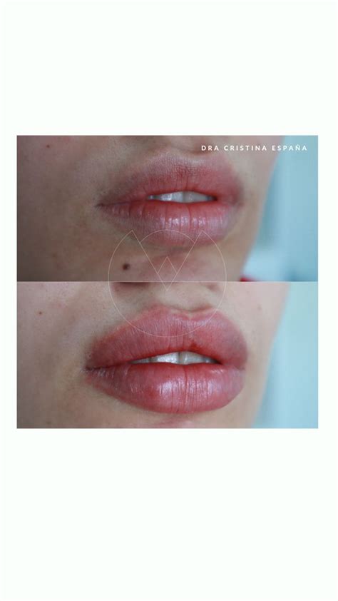 Lip injections with Juvederm filler. | Lip injections, Lip fillers ...